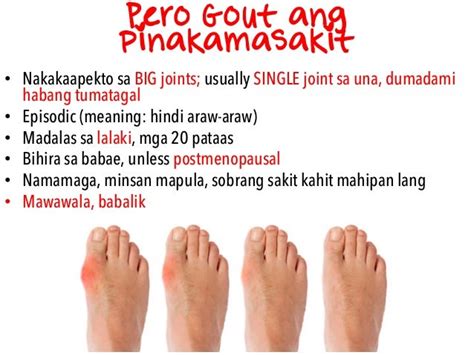 sintomas ng gout sa paa|Sintomas Ng Rayuma Sa Paa .